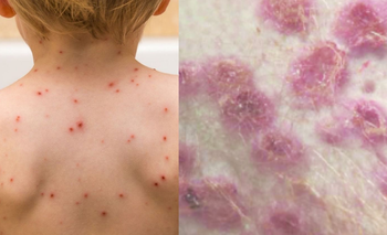 Diferencias entre viruela y varicela: qué síntomas existen en cada caso | Salud