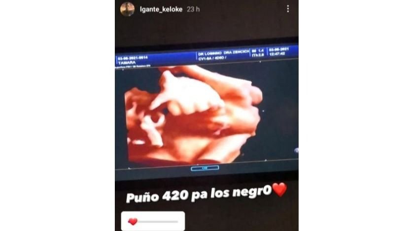 L-Gante hijo ecografía