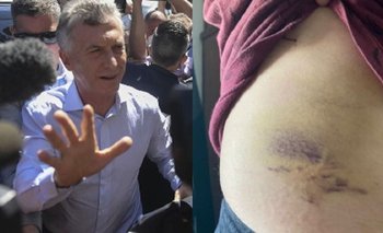 Así quedó el periodista que fue golpeado por custodios de Macri | Elecciones 2021