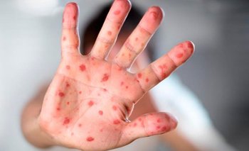 El gobierno declaró el alerta por un rebrote de sarampión  | Sarampión